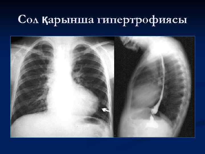 Сол қарынша гипертрофиясы 