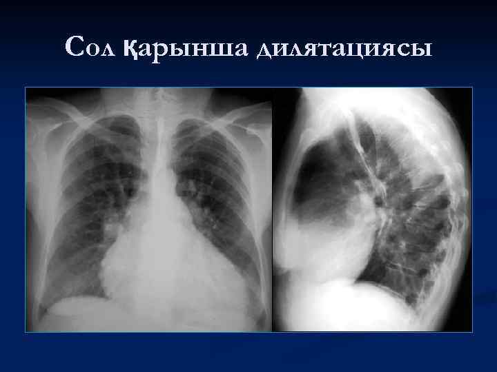 Сол қарынша дилятациясы 