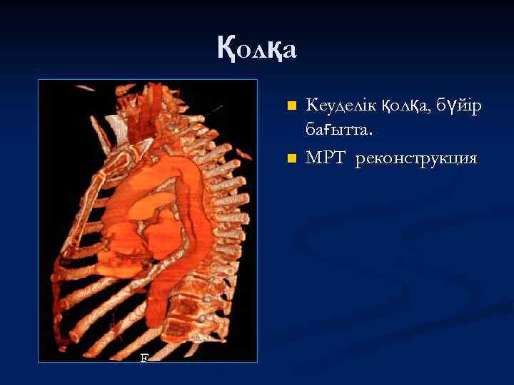 Қолқа n n Кеуделік қолқа, бүйір бағытта. МРТ реконструкция 