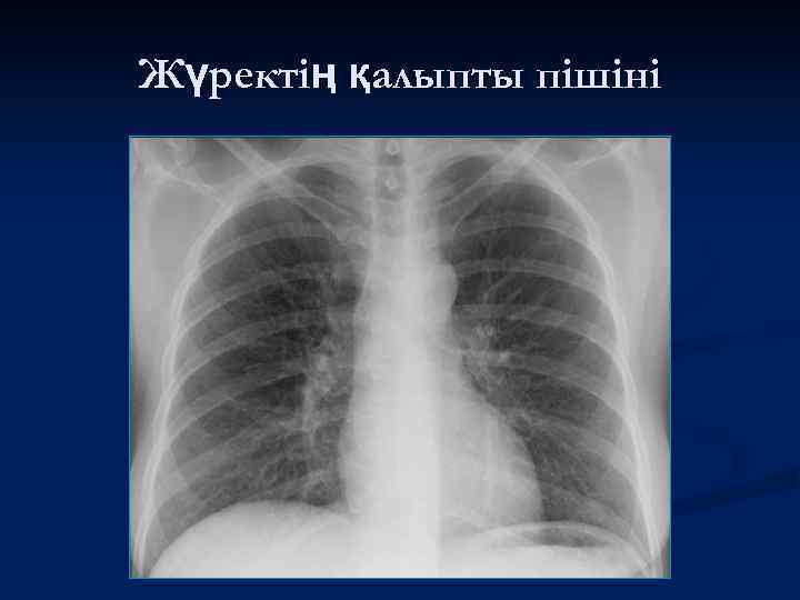 Жүректің қалыпты пішіні 