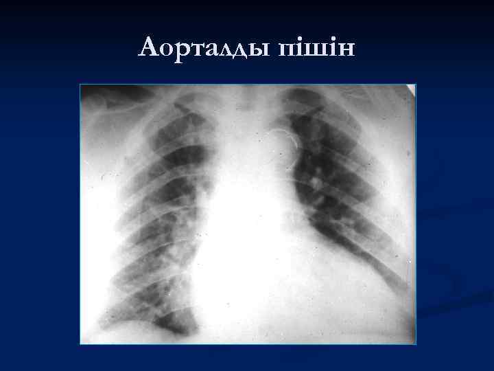 Аорталды пішін 