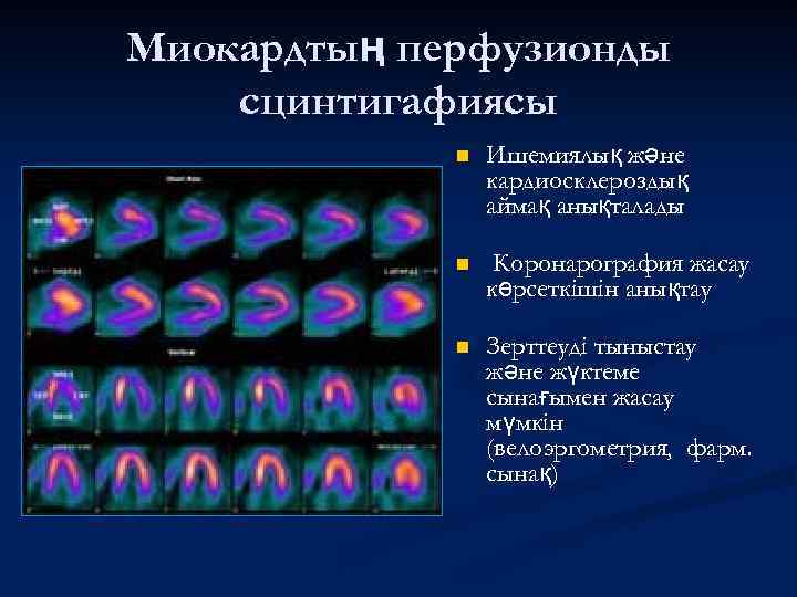 Миокардтың перфузионды сцинтигафиясы n Ишемиялық және кардиосклероздық аймақ анықталады n Коронарография жасау көрсеткішін анықтау