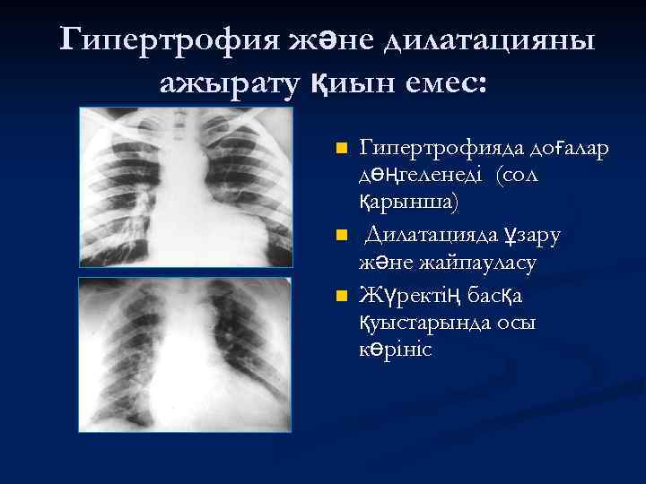 Гипертрофия және дилатацияны ажырату қиын емес: n n n Гипертрофияда доғалар дөңгеленеді (сол қарынша)