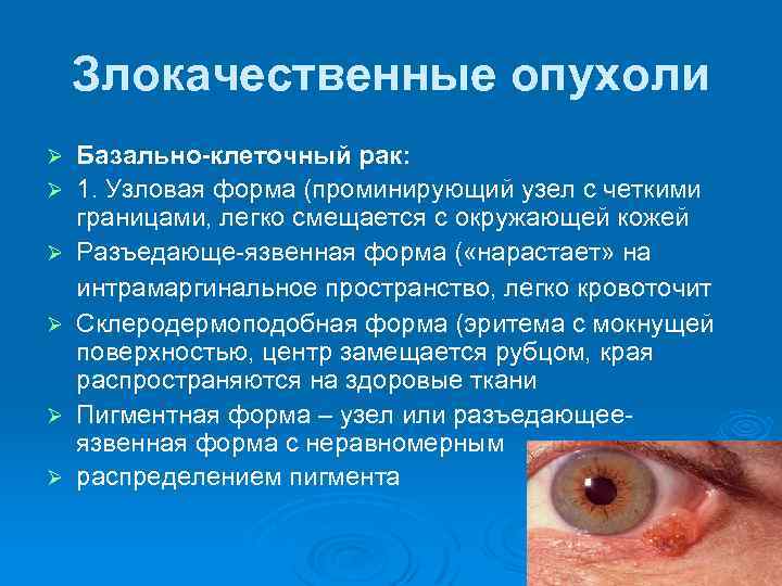 Злокачественные опухоли Ø Ø Ø Базально-клеточный рак: 1. Узловая форма (проминирующий узел с четкими