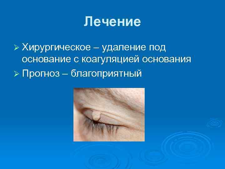 Лечение Ø Хирургическое – удаление под основание с коагуляцией основания Ø Прогноз – благоприятный