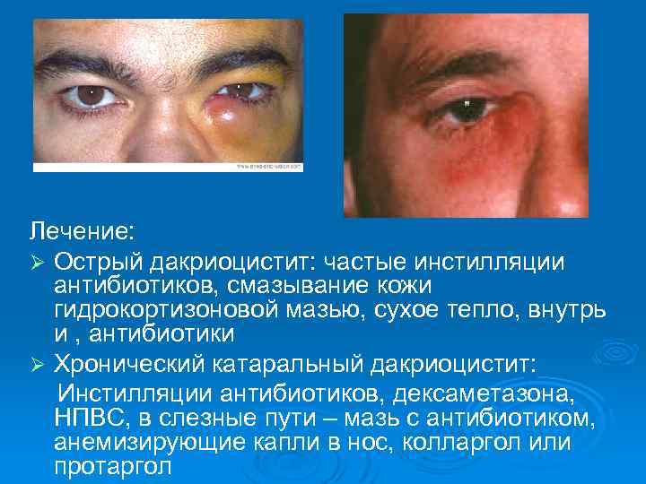 Лечение: Ø Острый дакриоцистит: частые инстилляции антибиотиков, смазывание кожи гидрокортизоновой мазью, сухое тепло, внутрь
