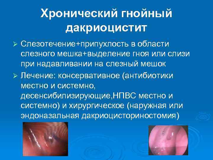 Хронический гнойный дакриоцистит Слезотечение+припухлость в области слезного мешка+выделение гноя или слизи при надавливании на