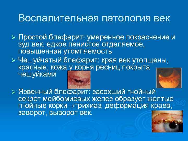 Воспалительная патология век Простой блефарит: умеренное покраснение и зуд век, едкое пенистое отделяемое, повышенная