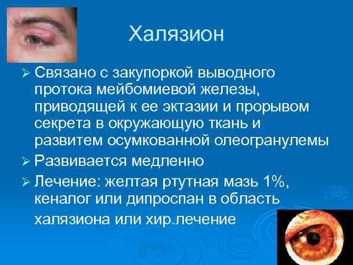 Халязион Ø Связано с закупоркой выводного протока мейбомиевой железы, приводящей к ее эктазии и