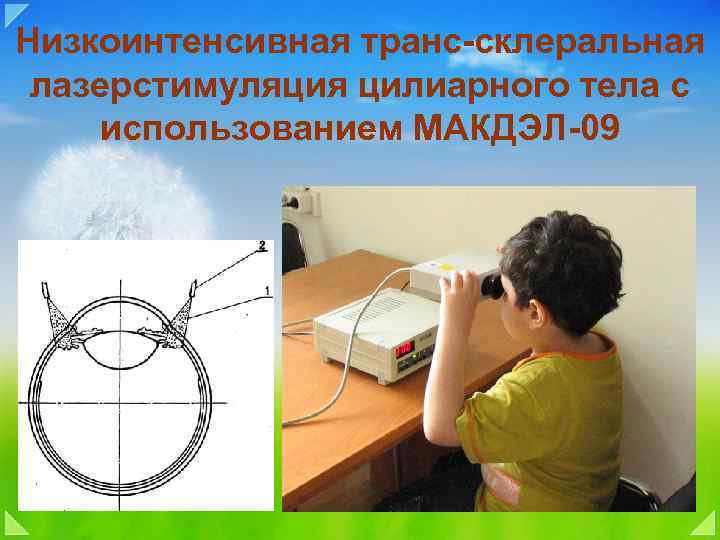 Низкоинтенсивная транс-склеральная лазерстимуляция цилиарного тела с использованием МАКДЭЛ-09 