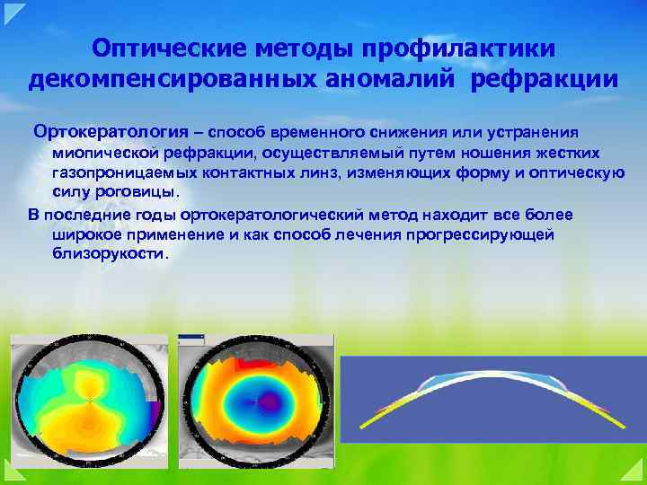 Оптические методы профилактики декомпенсированных аномалий рефракции Ортокератология – способ временного снижения или устранения миопической