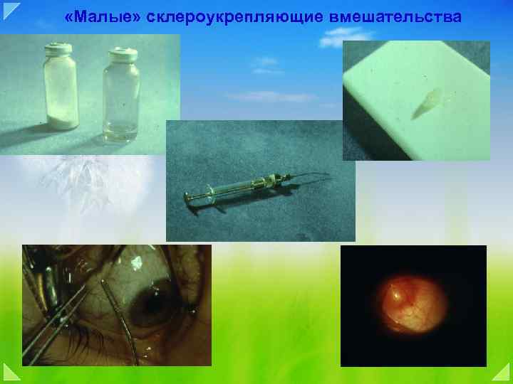  «Малые» склероукрепляющие вмешательства 