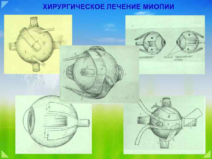 ХИРУРГИЧЕСКОЕ ЛЕЧЕНИЕ МИОПИИ 