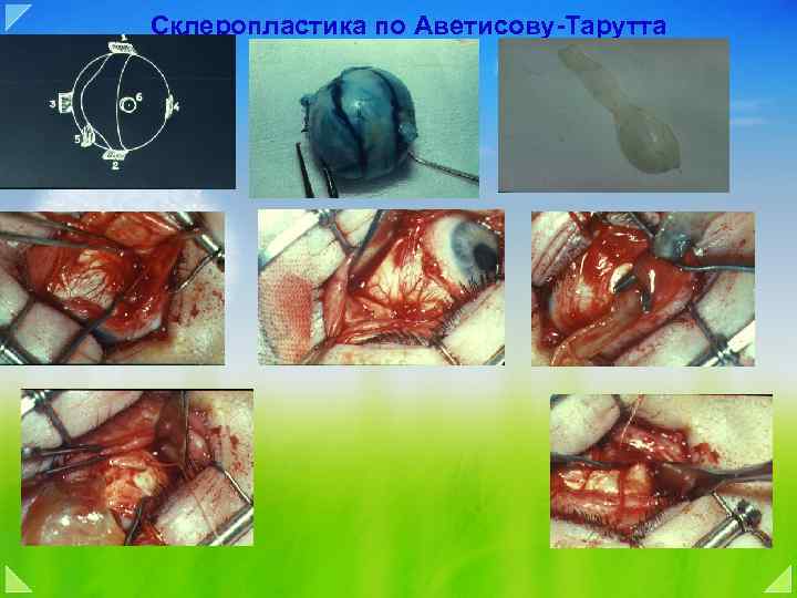Склеропластика по Аветисову-Тарутта 
