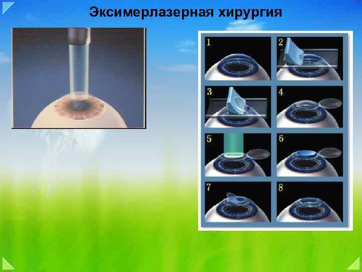 Эксимерлазерная хирургия 