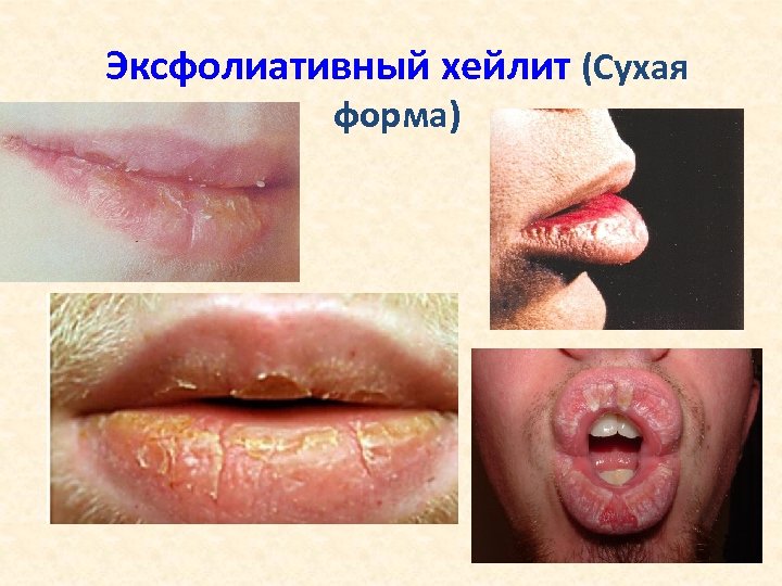 Эксфолиативный хейлит (Сухая форма) 