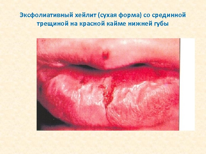 Эксфолиативный хейлит (сухая форма) со срединной трещиной на красной кайме нижней губы 