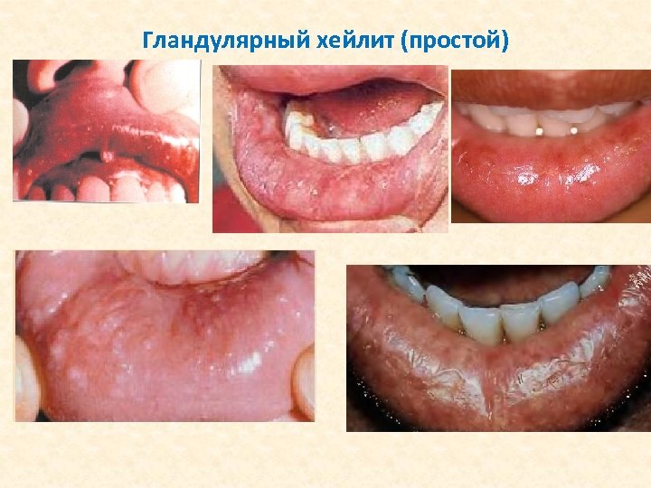 Гландулярный хейлит (простой) 