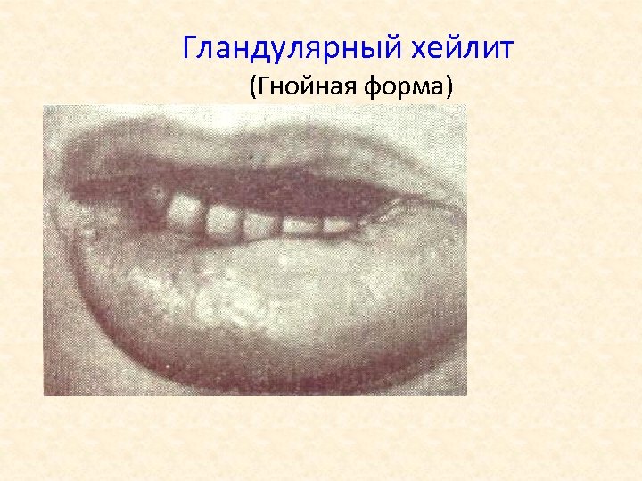 Гландулярный хейлит (Гнойная форма) 