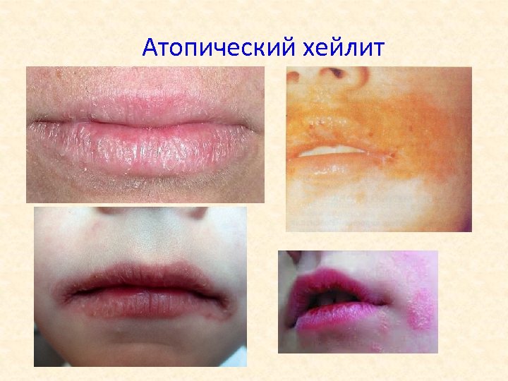Атопический хейлит 