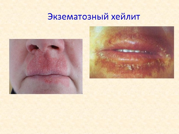 Экзематозный хейлит 