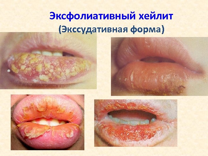 Эксфолиативный хейлит (Экссудативная форма) 