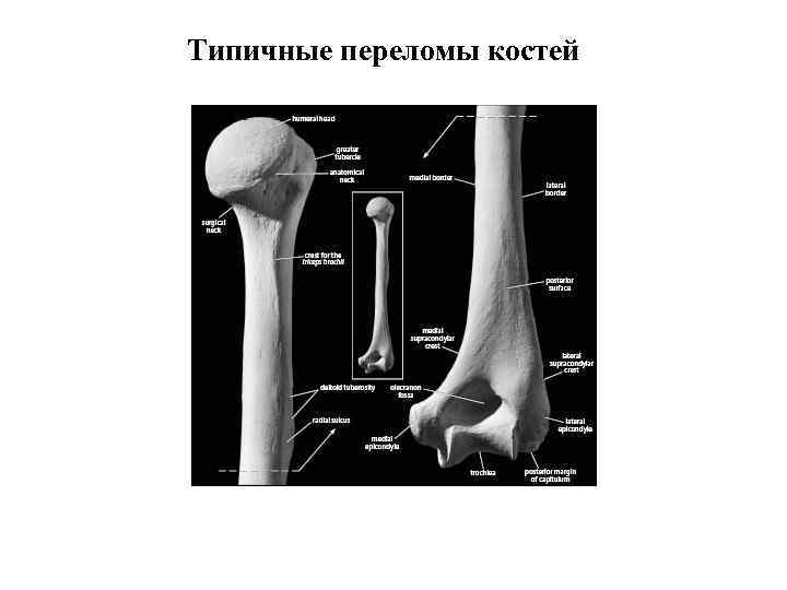 Типичные переломы костей 