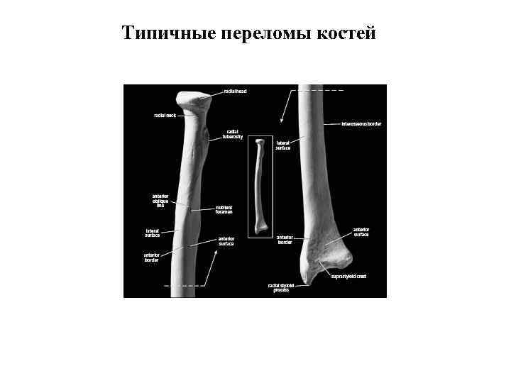 Типичные переломы костей 