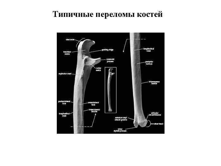 Типичные переломы костей 