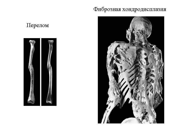 Переломы трубчатых костей