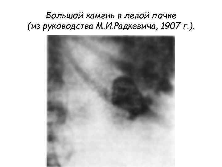 Большой камень в левой почке (из руководства М. И. Радкевича, 1907 г. ). 