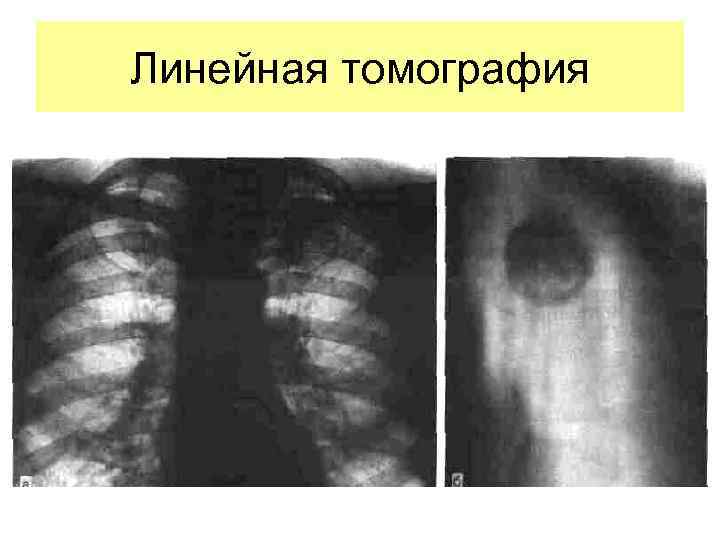 Линейная томография 