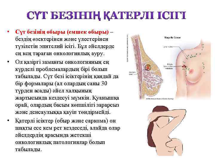  • Сүт безінің обыры (емшек обыры) – бездің өзектерінен және үлестерінен түзілетін эпителий