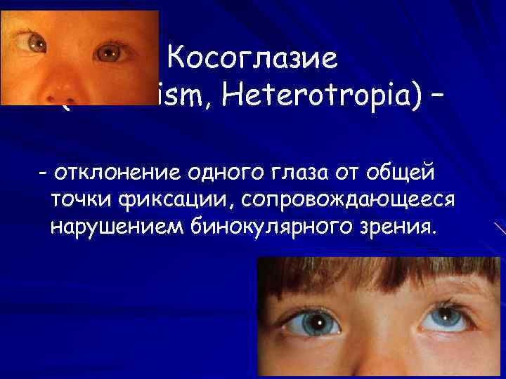 Косоглазие (Strabism, Heterotropia) – - отклонение одного глаза от общей точки фиксации, сопровождающееся нарушением