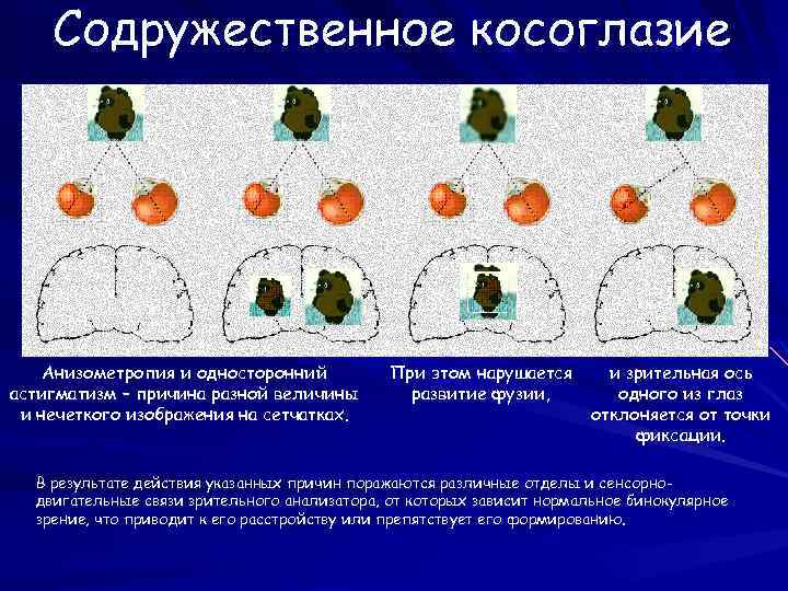 Содружественное косоглазие Анизометропия и односторонний астигматизм – причина разной величины и нечеткого изображения на