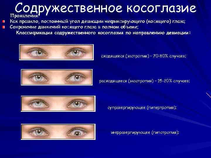 Содружественное косоглазие Проявления: Как правило, постоянный угол девиации нефиксирующего (косящего) глаза; Сохранение движений косящего