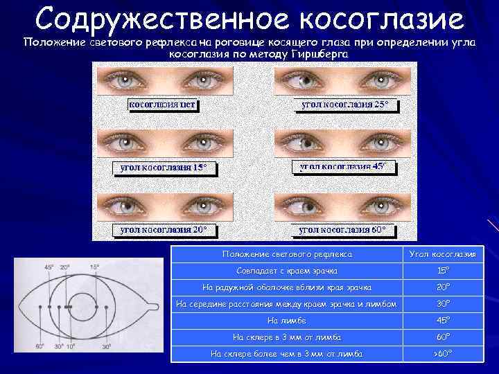 Содружественное косоглазие Положение светового рефлекса на роговице косящего глаза при определении угла косоглазия по