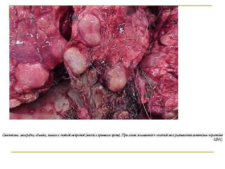 Симптомы: лихорадка, одышка, кашель с гнойной мокротой (иногда с примесью крови). При заносе гельминтов