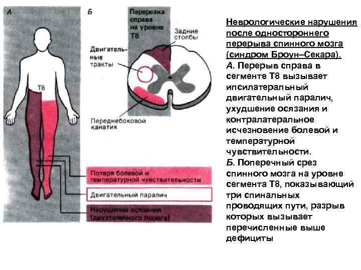 Неврологические нарушения после одностороннего перерыва спинного мозга (синдром Броун–Секара). А. Перерыв справа в сегменте