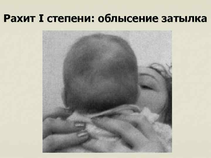 Рахит I степени: облысение затылка 