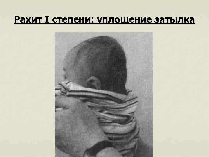 Рахит I степени: уплощение затылка 