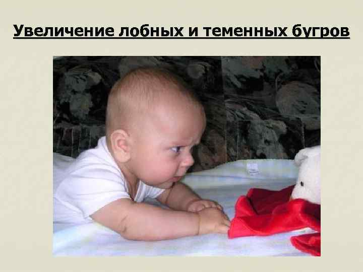 Увеличение лобных и теменных бугров 