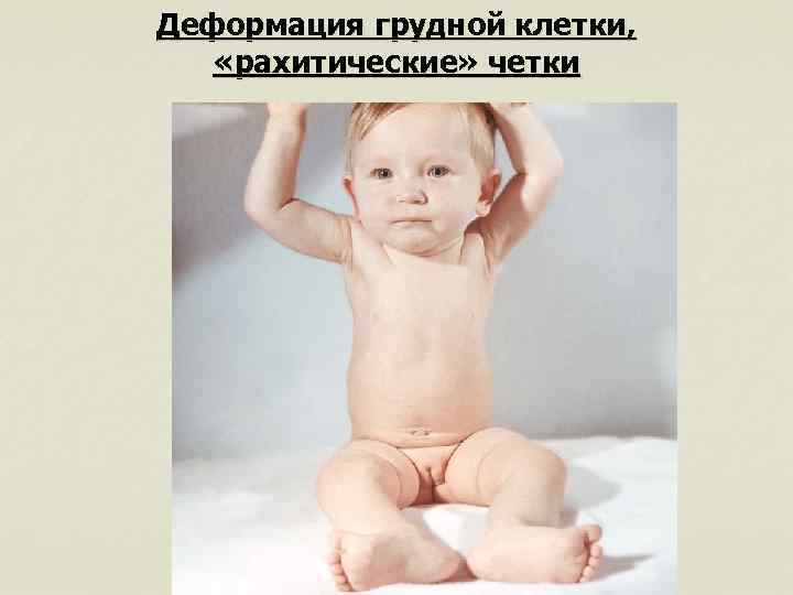 Деформация грудной клетки, «рахитические» четки 
