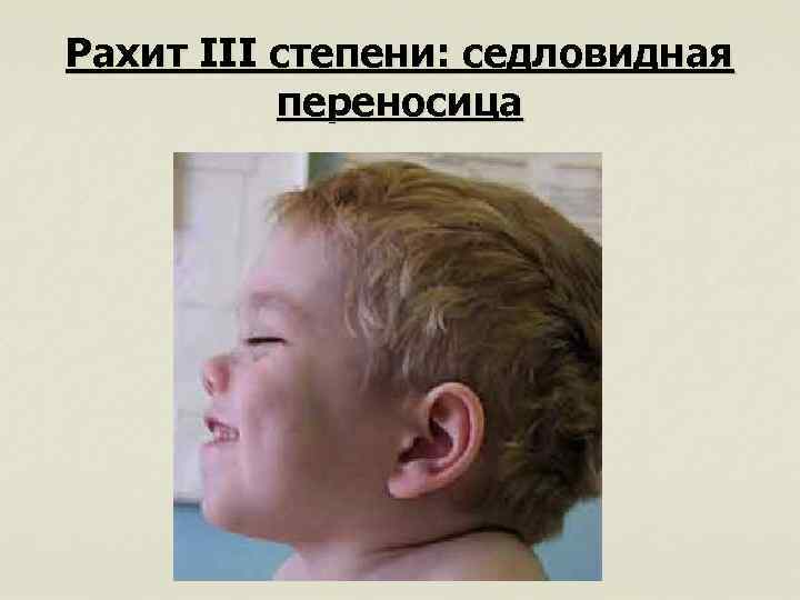 Рахит III степени: седловидная переносица 