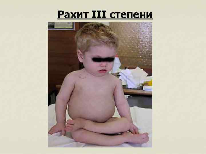 Рахит III степени 
