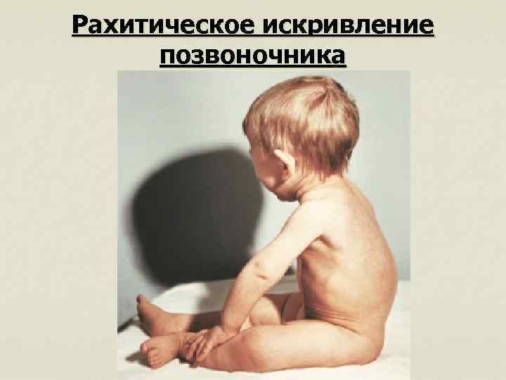 Рахитическое искривление позвоночника 