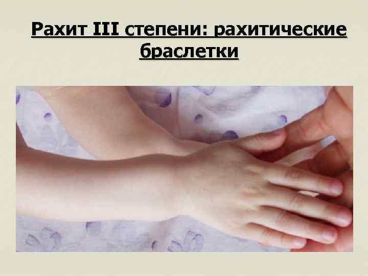 Рахит III степени: рахитические браслетки 