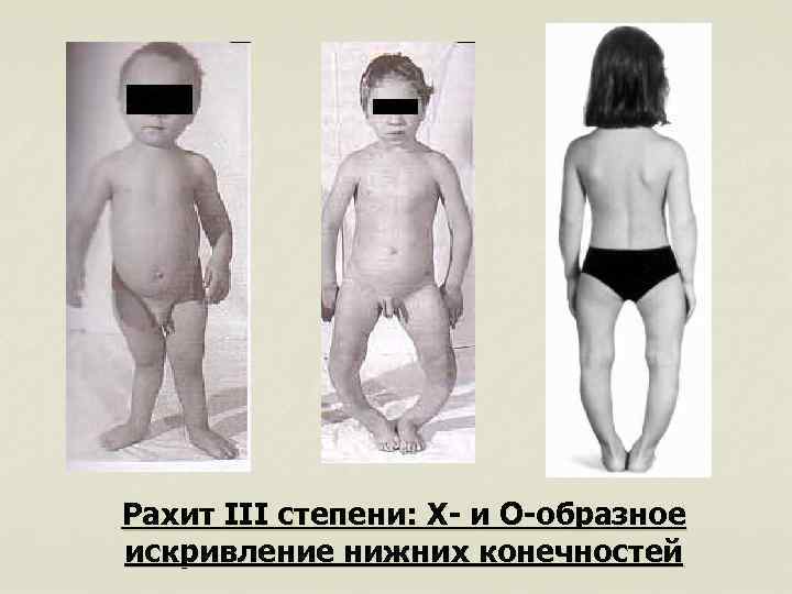 Рахит III степени: Х- и О-образное искривление нижних конечностей 