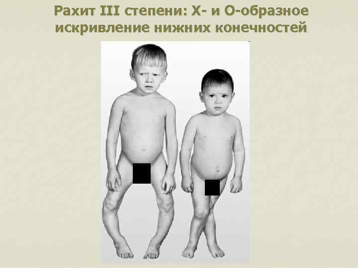Рахит III степени: Х- и О-образное искривление нижних конечностей 