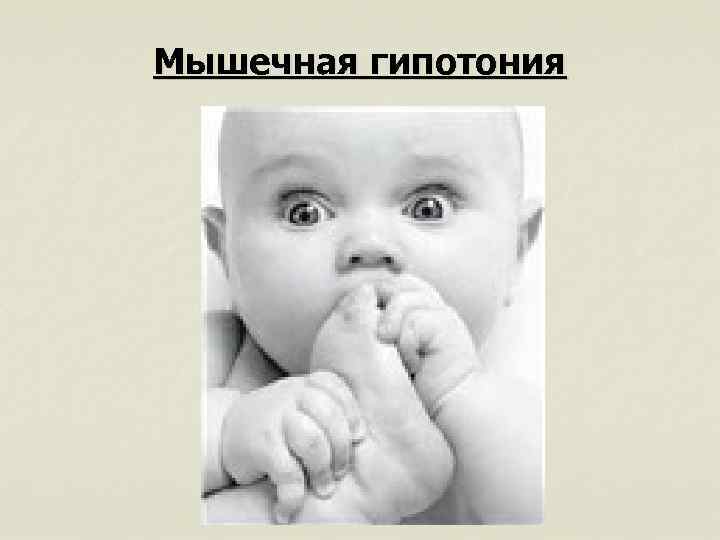 Мышечная гипотония 